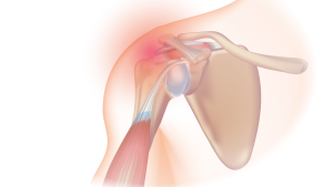 INTEL: Internet-delivered primary care for shoulder pain