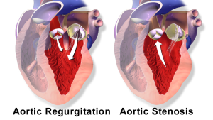 EASY-AS: Early valve replacement in severe ASYmptomatic Aortic Stenosis